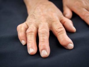 Comment prevenir et traiter arthrose des mains