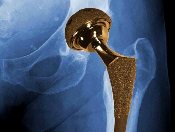 Demandez si votre nouvelle articulation de la hanche a un bon bilan avant la chirurgie