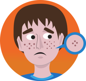 Les causes de l'acné chez l'adulte et comment s'en débarrasser