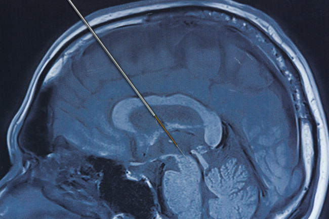Lire la suite à propos de l’article Qu&rsquo;est-ce que la stimulation cérébrale profonde et pourquoi fonctionne-t-elle pour la maladie de Parkinson?